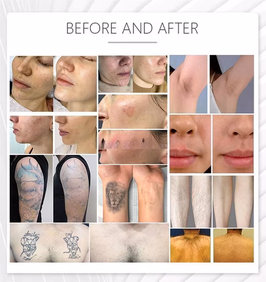 2023 M22 IPL Opt Skin Photon Rejuvenecimiento Equipo de belleza Aopt Laser M22 Lumenis Resurfx Cool Hair Removal Machine